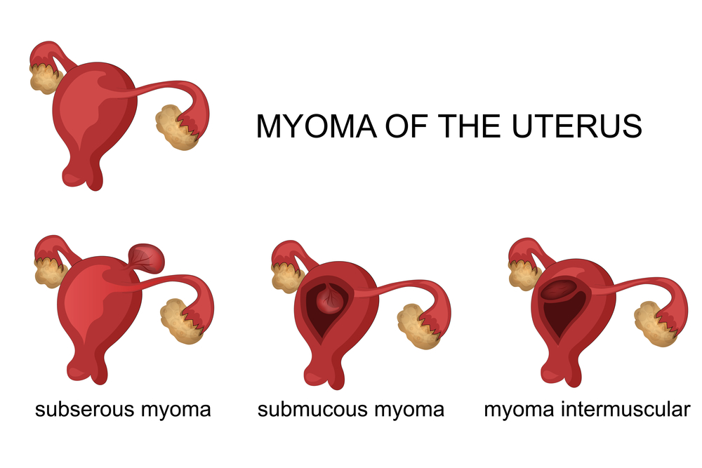 Dieses Bild zeigt die unterschiedlichen Myom Arten der Gebärmutter.